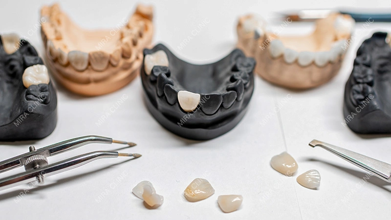 Number of veneers